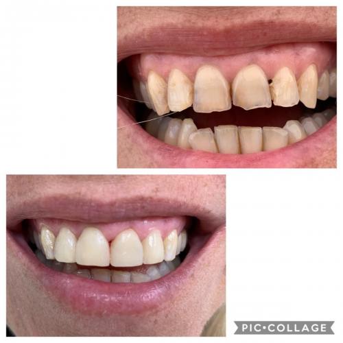 Cosmetic DentistryComposite Veneers