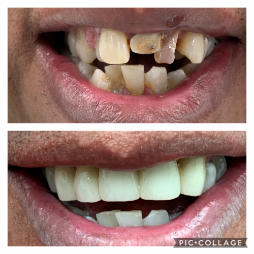 Upper Mouth Reconstruction